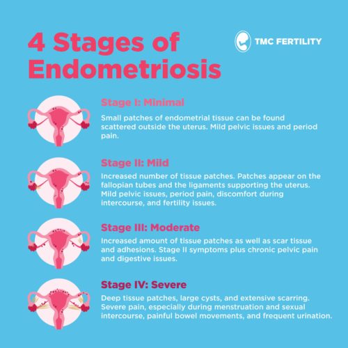 endometriosis 3