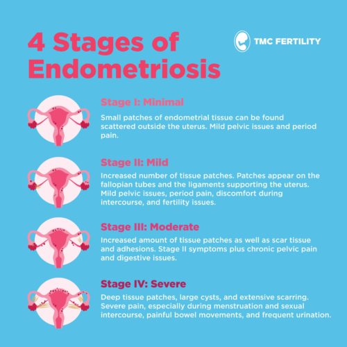 endometriosis 3